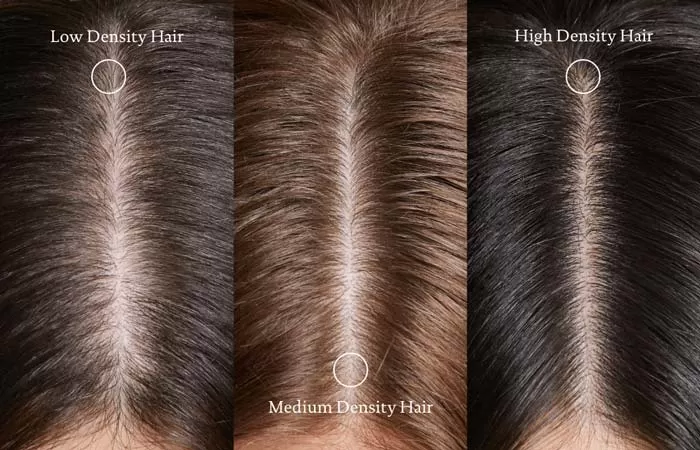 تراکم مو (Hair Density)
